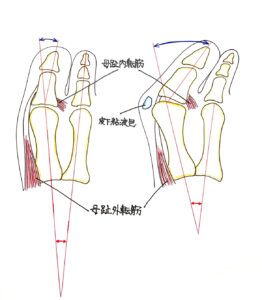 外反母趾